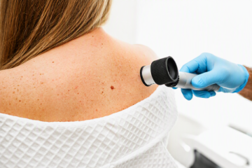 Kůže si pamatuje každé spálení: Jak nedat melanomu šanci