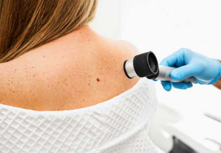 Kůže si pamatuje každé spálení: Jak nedat melanomu šanci