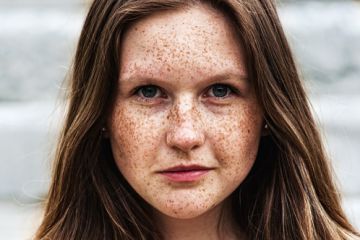 Pigmentace kůže – co ji způsobuje, příklady poruch pigmentace