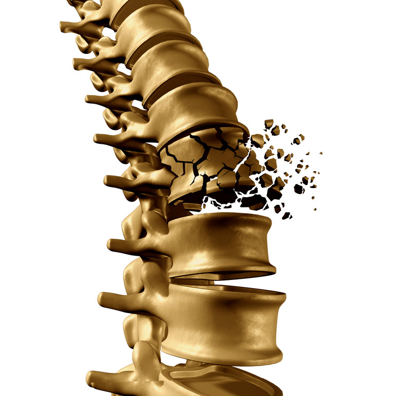 Osteoporóza: Proč nám řídnou kosti?